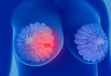 Bahia recebe remédio inovador contra tipo agressivo de câncer de mama